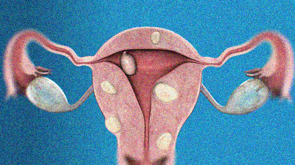 Living with uterine fibroids