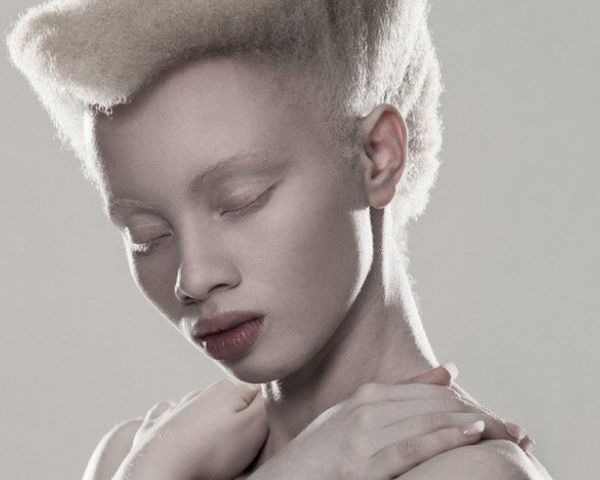 Albinism and perceptions of beauty