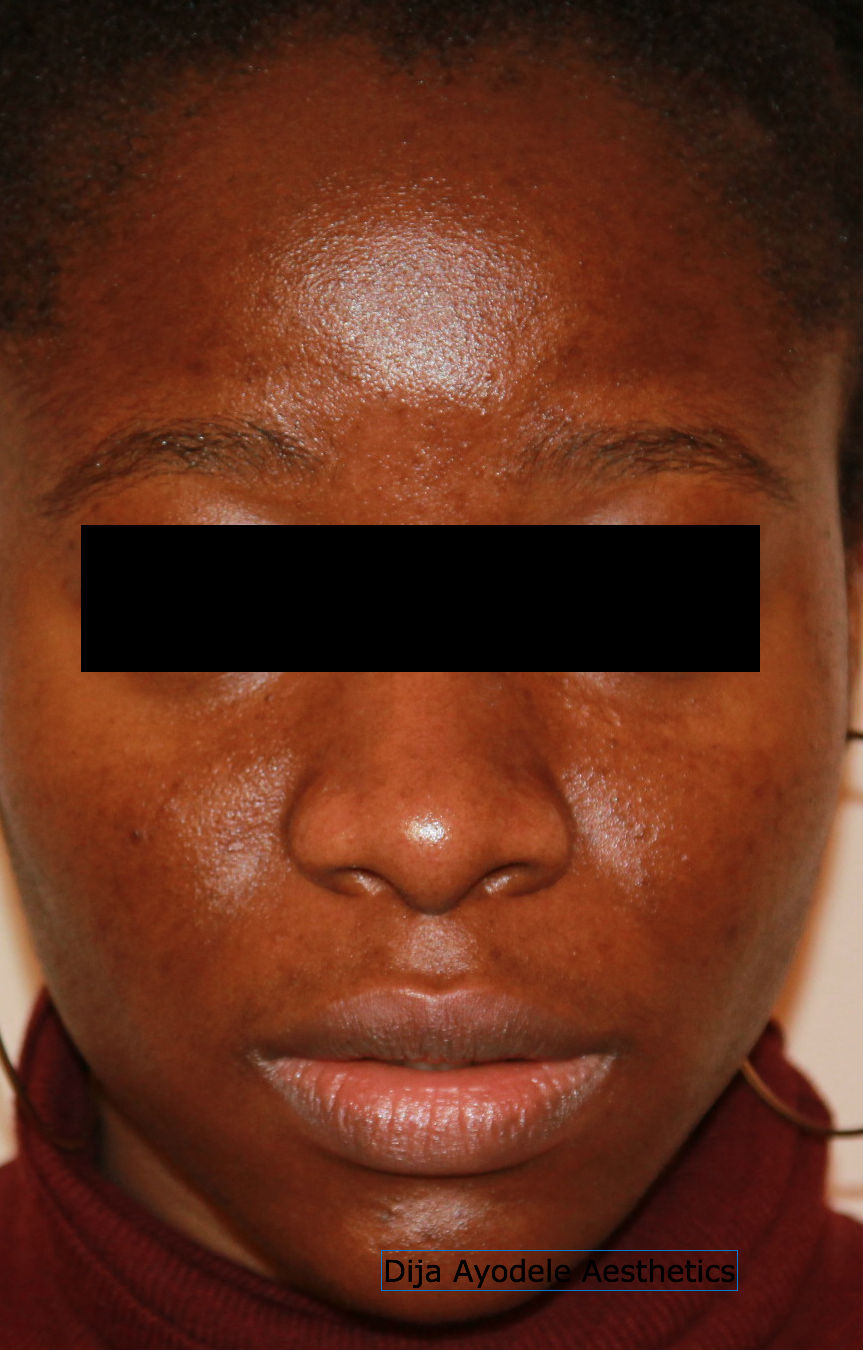 What no one tells you about chemical peels for black skin