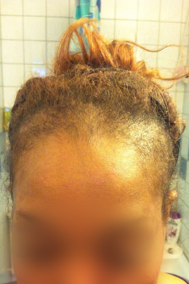 A guide to hair transplants for afro hair | A guide to hair transplants for afro hair |