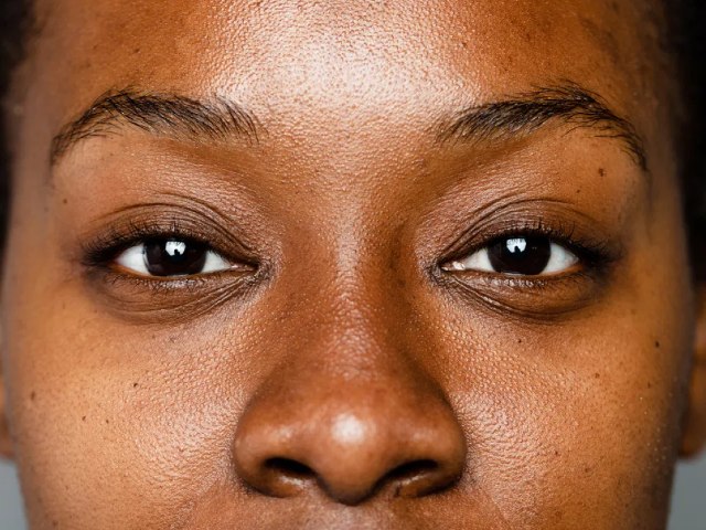 Best Ingredients for Treating Hyperpigmentation in Dark Skin